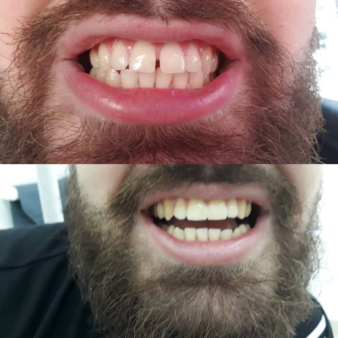 Transformação de Sorriso (antes e depois)